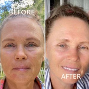 Before-and-After effect while using SENSITIVE SKIN products